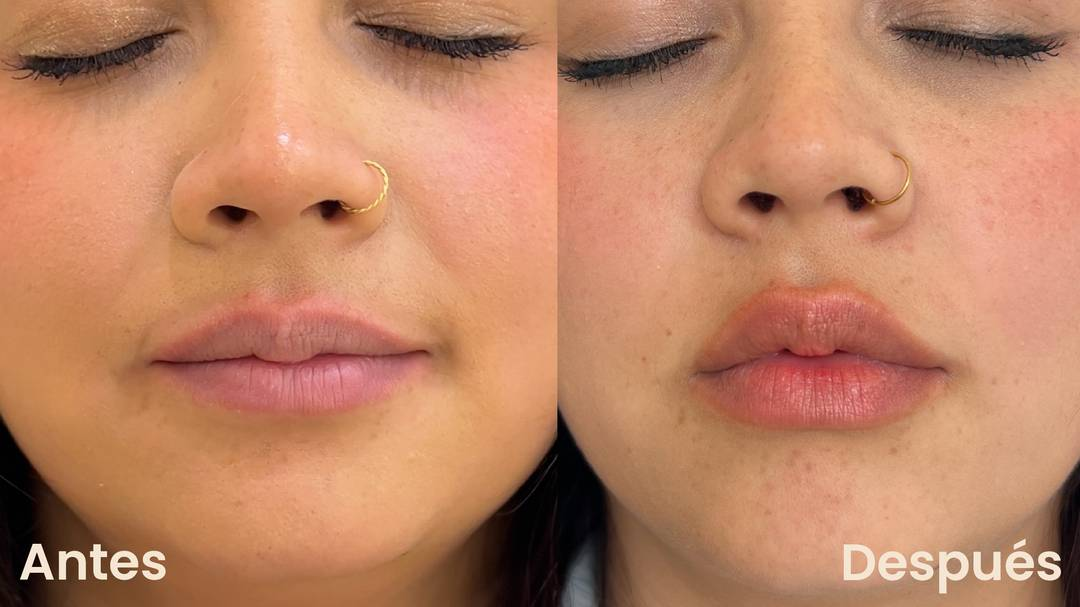 Ácido hialurónico antes y después en labios - Botoshop Bogotá