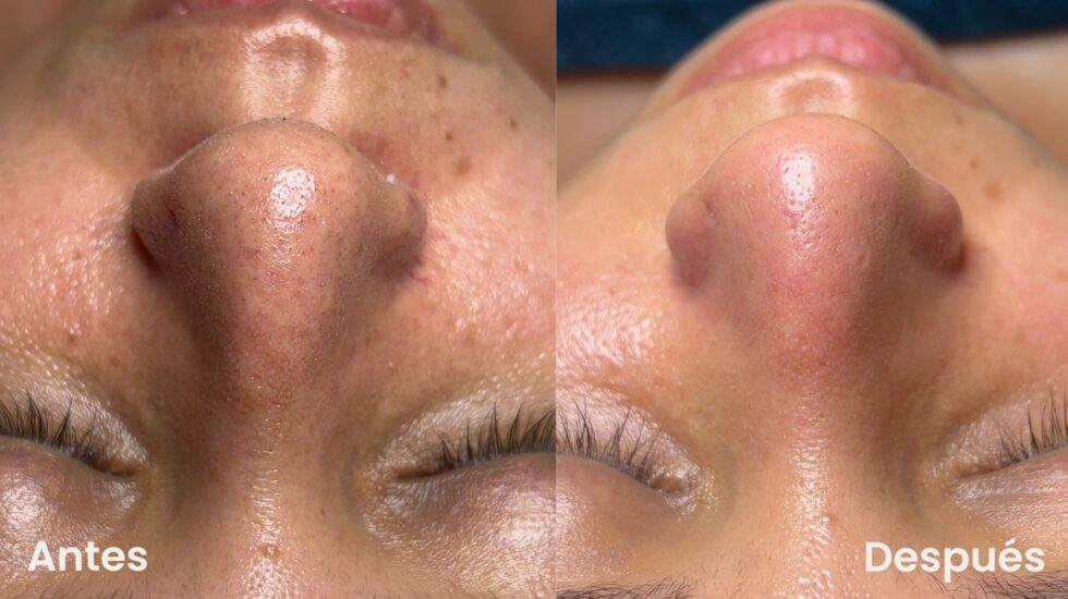 Limpieza facial profunda antes y después en nariz - Botoshop Bogotá