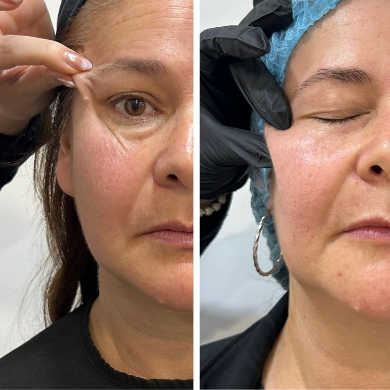 Antes y después de Rejuvenecimiento Facial con Bioestimulador de Colágeno Sculptra