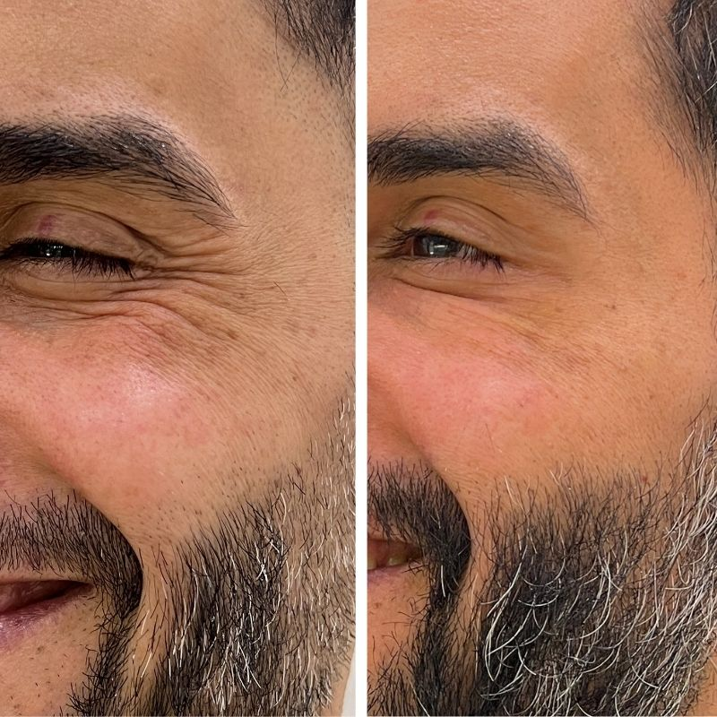 Antes y después de Toxina Botulínica en contorno de ojos en hombre