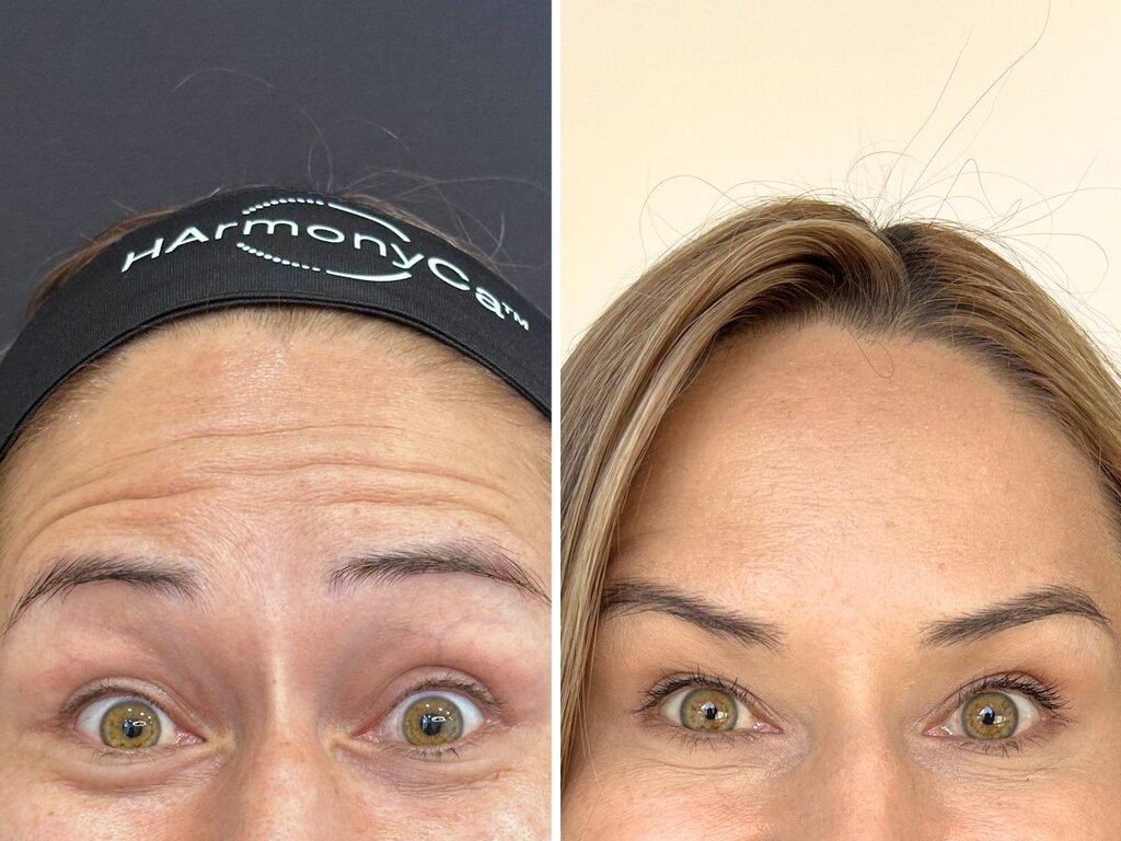 Antes y después de Rejuvenecimiento Facial en Botoshop Bogotá