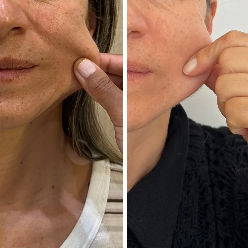 Antes y después de Radiesse en Botoshop