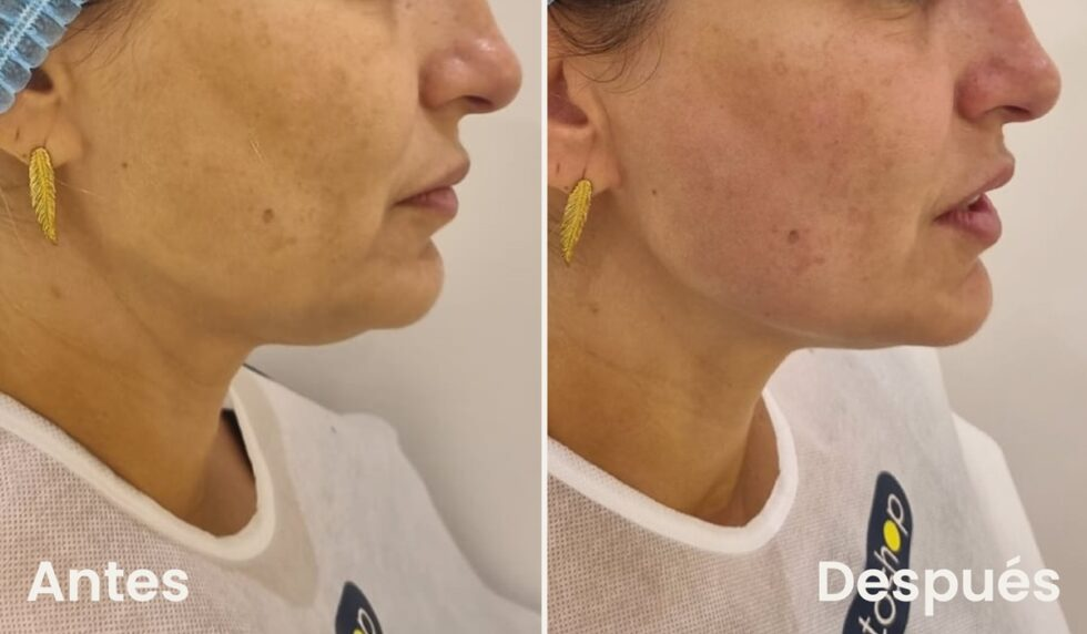 HArmonyCa antes y después en ángulo mandibular - Botoshop Bogotá