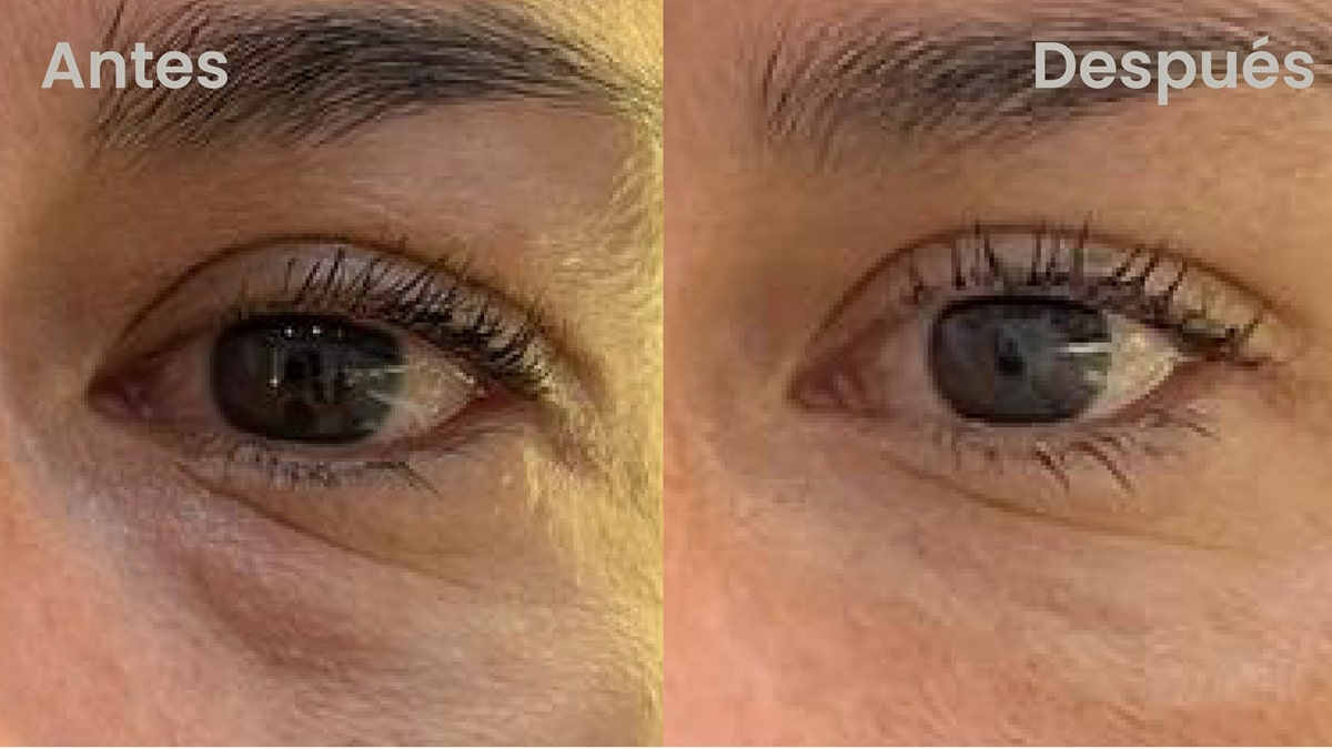 Ácido hialurónico antes y después en ojeras - Botoshop Bogotá