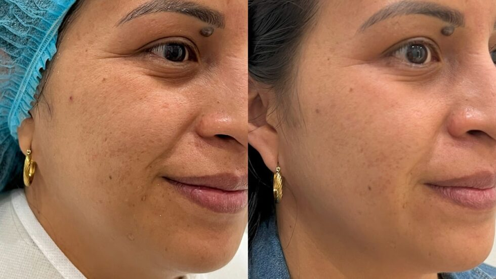 Peeling antes y después en rostro - Botoshop Bogotá
