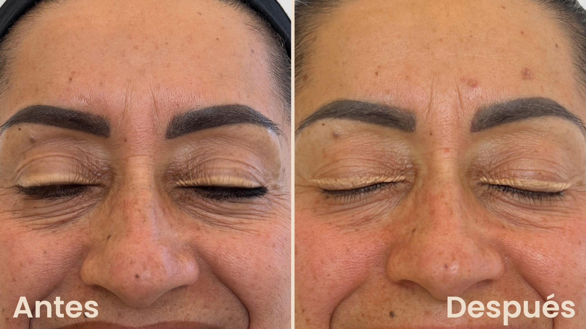 NCTF 135HA antes y después en ojeras - Botoshop Bogotá