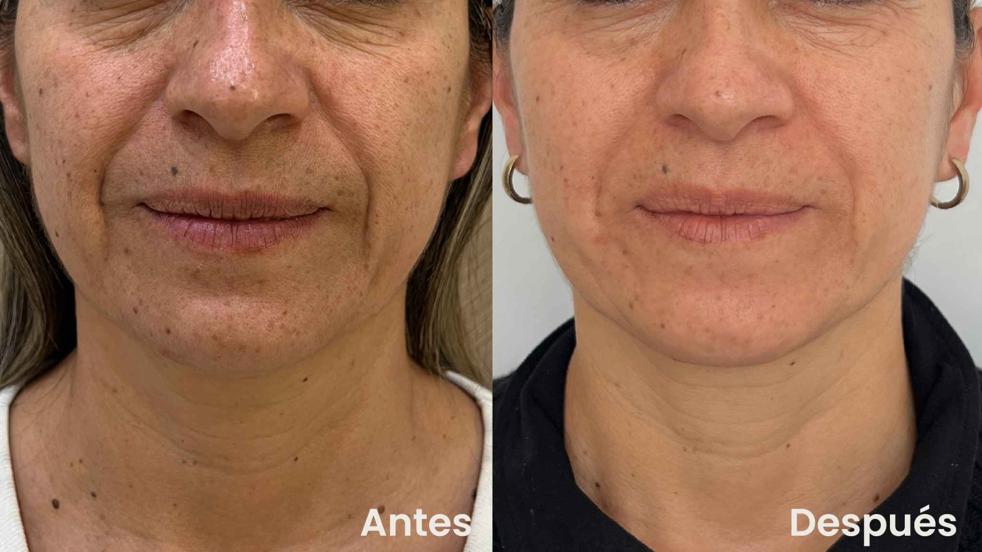 Radiesse antes y después en tercio inferior del rostro - Botoshop Bogotá