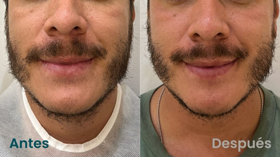 Tensamax facial antes y después en papada, frontal - Botoshop Bogotá