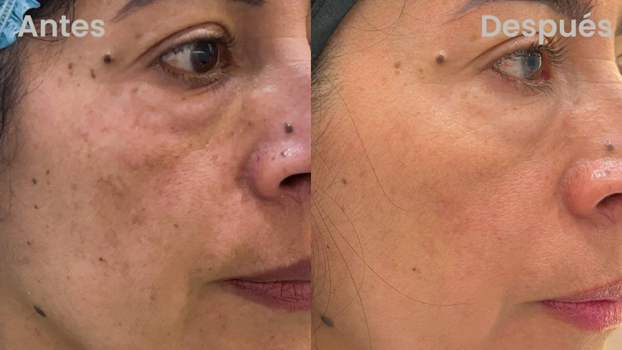 Nanopore antes y después en rostro - Botoshop Bogotá