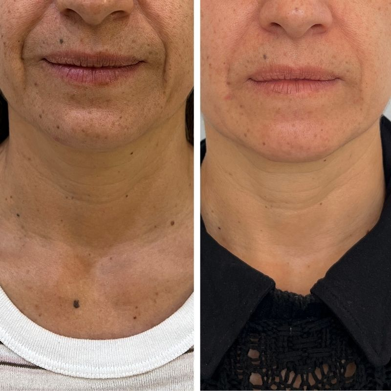 Antes y después de Rejuvenecimiento Facial con Radiesse en cuello