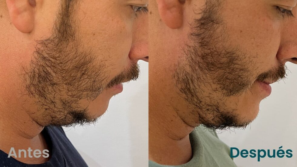 Tensamax facial antes y después en papada, perfil - Botoshop Bogotá
