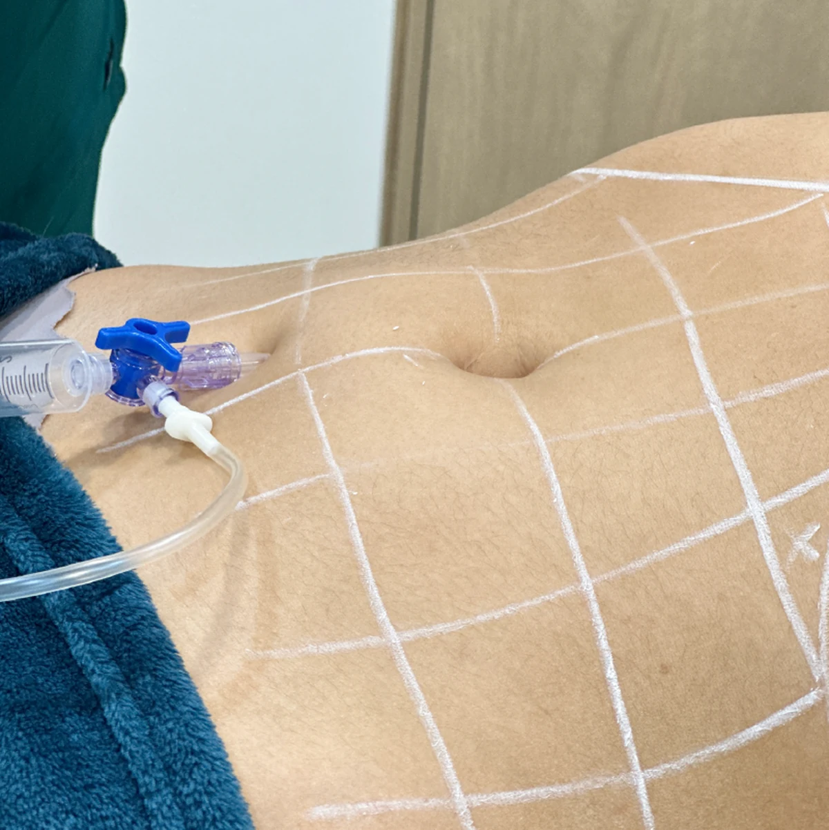 Hidrolipoclasia en Botoshop Bogotá — Armonización Facial y Corporal