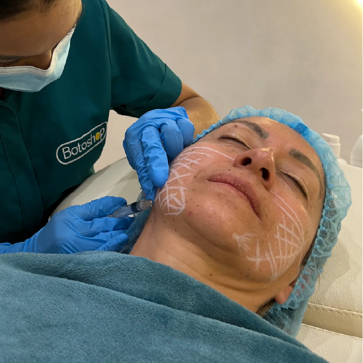 Radiesse para Rejuvenecimiento Facial y Estimulación de Colágeno