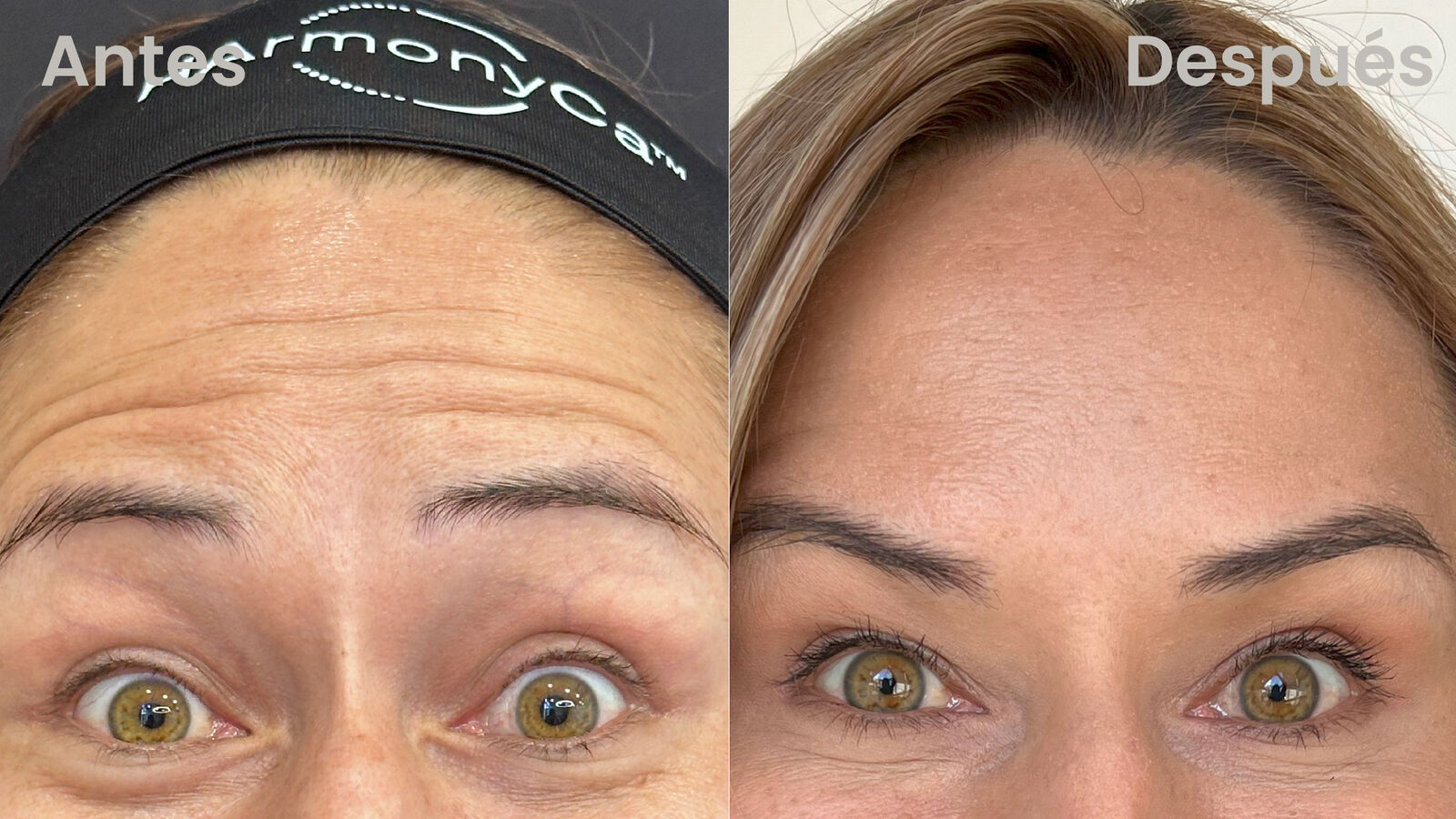Bótox antes y después en entrecejo - resultado Botoshop