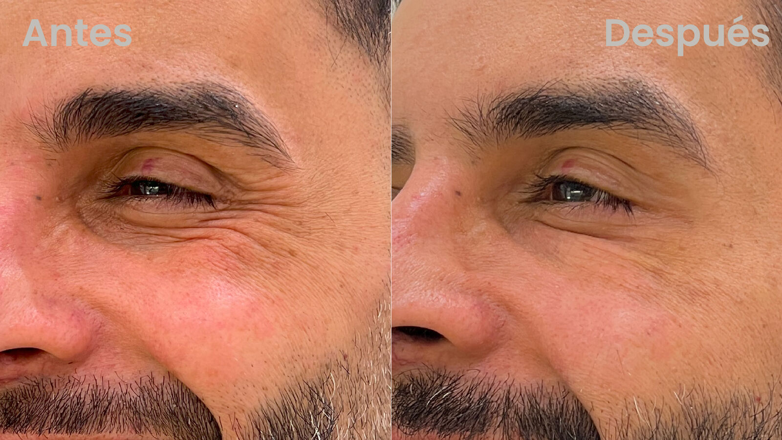 Bótox antes y después en patas de gallina - resultado Botoshop