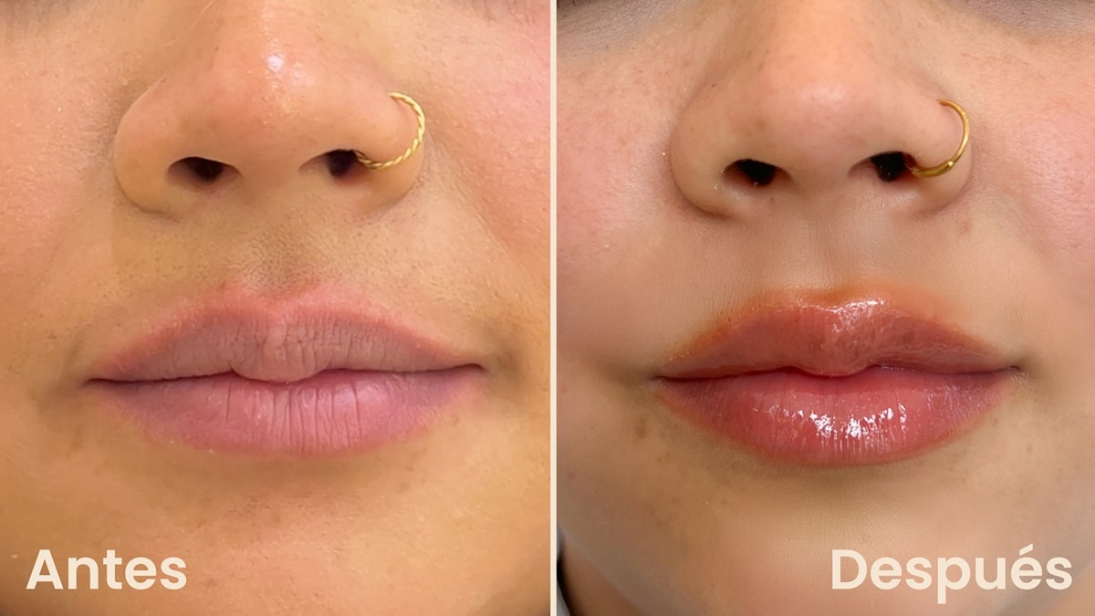 Ácido Hialurónico de Volumen: resultados visibles antes y después del tratamiento. Comparación antes y después de la aplicación de Ácido Hialurónico de Volumen para aumentar y definir labios