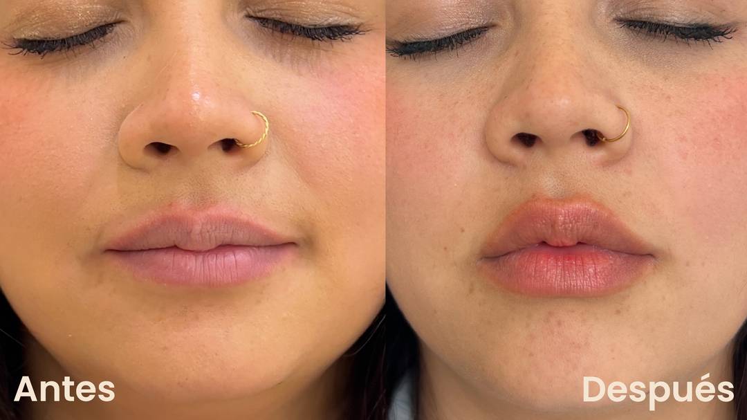 Comparación antes y después de la aplicación de Ácido Hialurónico de Volumen para aumentar y definir labios