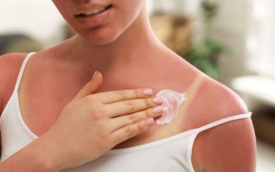 ¿Cómo recuperar la piel después de vacaciones?