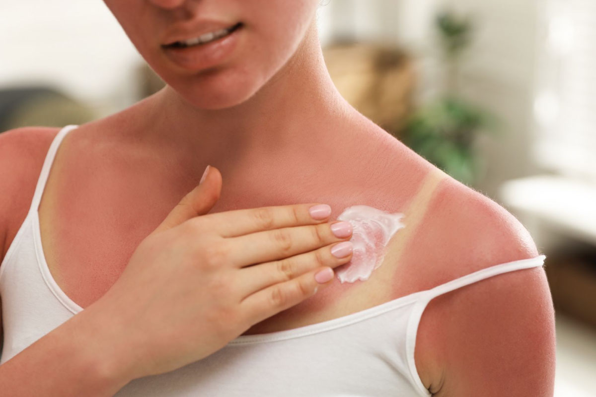 Antes, durante y después: cuida tu piel en vacaciones Mujer recuperando su piel suave con productos de skincare después de quemarse con el sol.