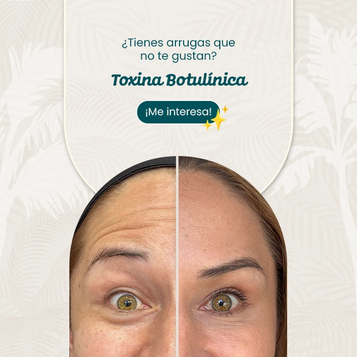 Comparativa de frente femenina antes y después de tratamiento estético con toxina botulínica, enfocada en la reducción de arrugas