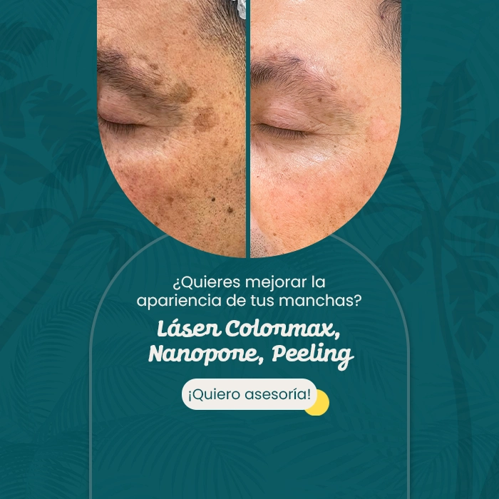 Comparativa del rostro masculino mostrando mejora en manchas cutáneas tras tratamiento estético no invasivo, junto a mensaje promocional