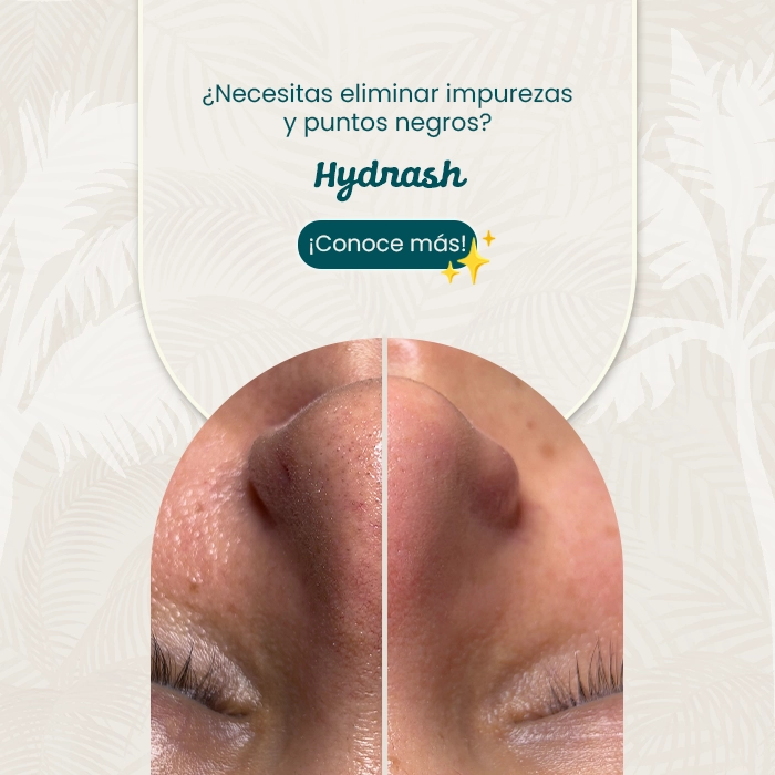 Comparativa de nariz con puntos negros y piel limpia tras tratamiento facial de limpieza profunda, junto a mensaje promocional