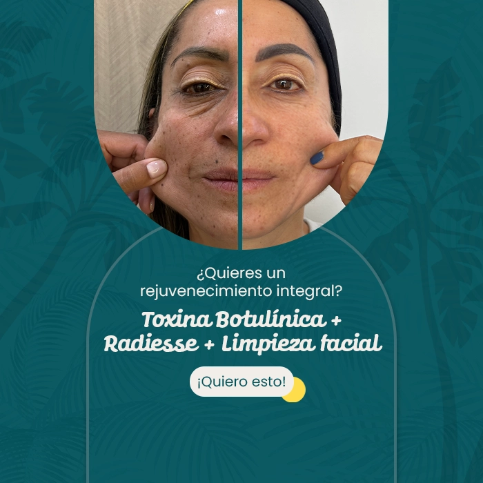 Comparativa del rostro de una mujer antes y después de un tratamiento estético integral con toxina botulínica, Radiesse y limpieza facial; se muestra un lado con signos de envejecimiento y el otro con piel más firme y rejuvenecida.