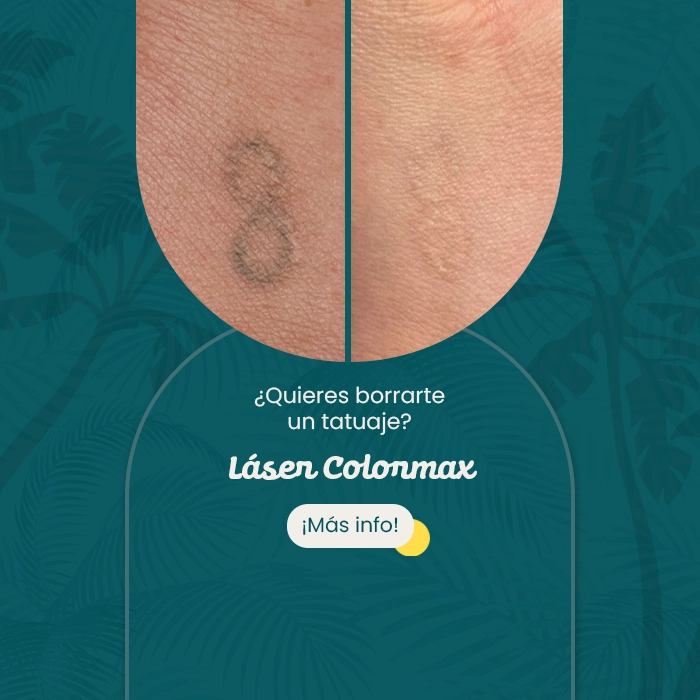 Comparativa de piel antes y después de procedimiento estético para eliminación de tatuaje con láser, junto a mensaje promocional