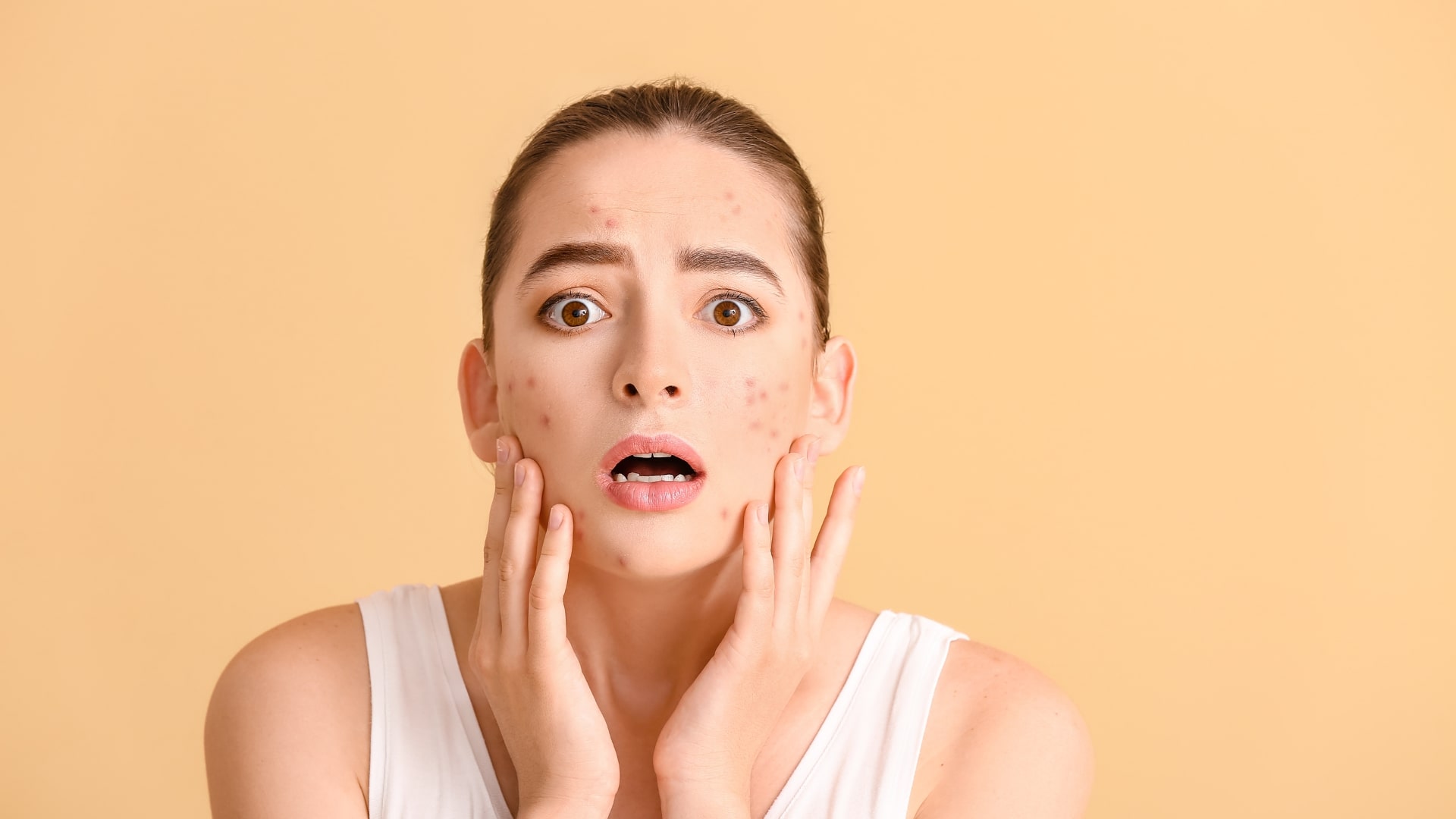 acne-vs-rosaea-1 Mujer sorprendida sin saber si padece acné o rosácea