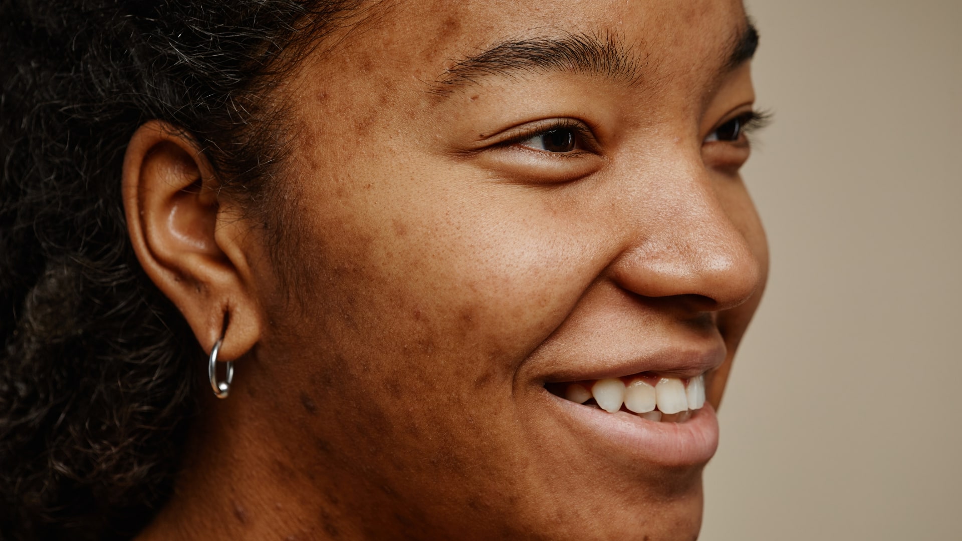 Mujer sonriente , se visualiza en su piel rosácea o acné