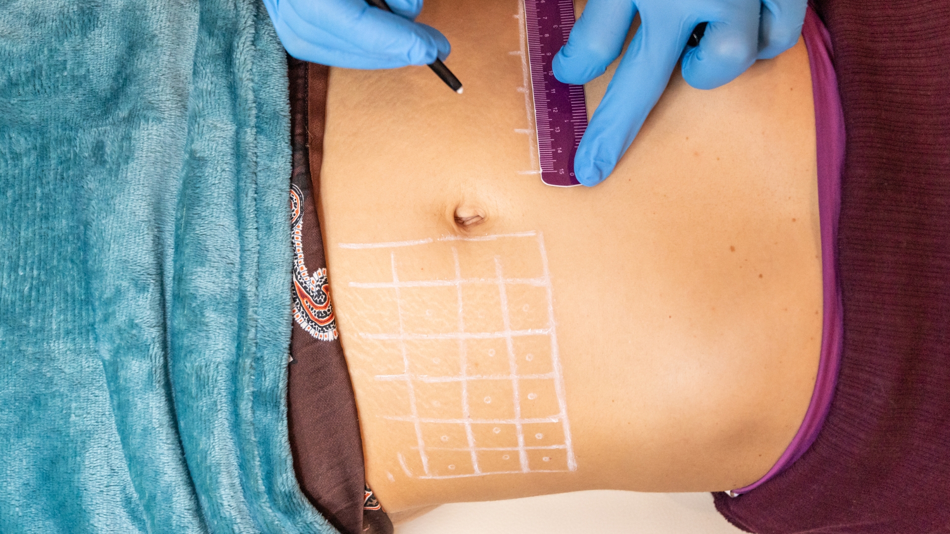 Primer plano de un abdomen con guantes azules trazando una cuadrícula de líneas blancas sobre la piel.