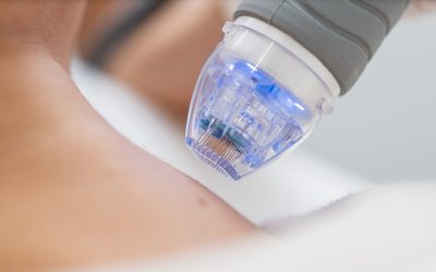 Nanopore vs. Dermapen: ¿cuál es mejor para tu piel?