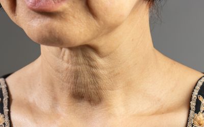 ¿Cuál es el mejor bioestimulador de colágeno para tu piel? Radiesse vs. Harmonyca