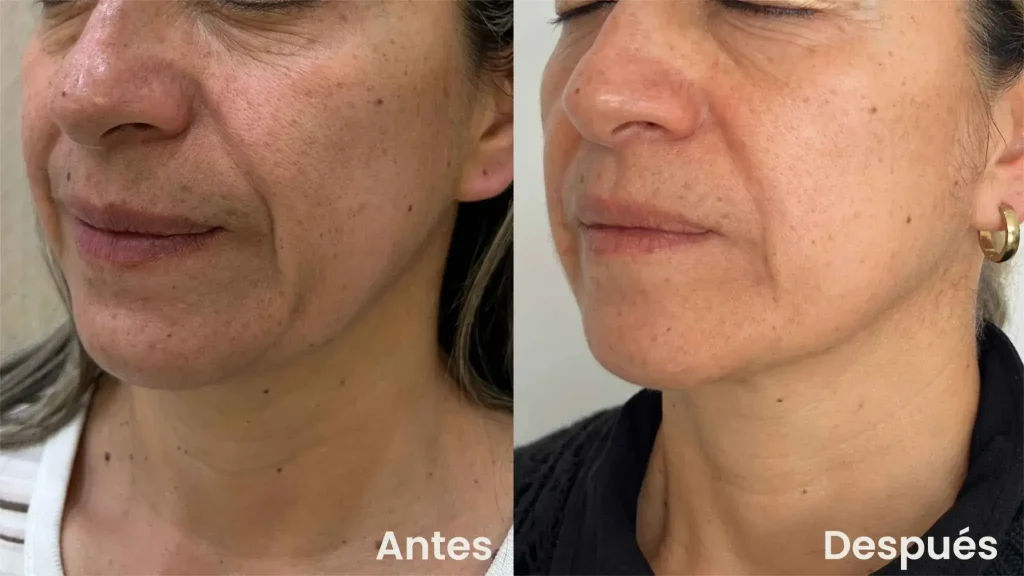 Antes y después tratamiento Radiesse para flacidez en rostro en clínica estética en Bogotá 