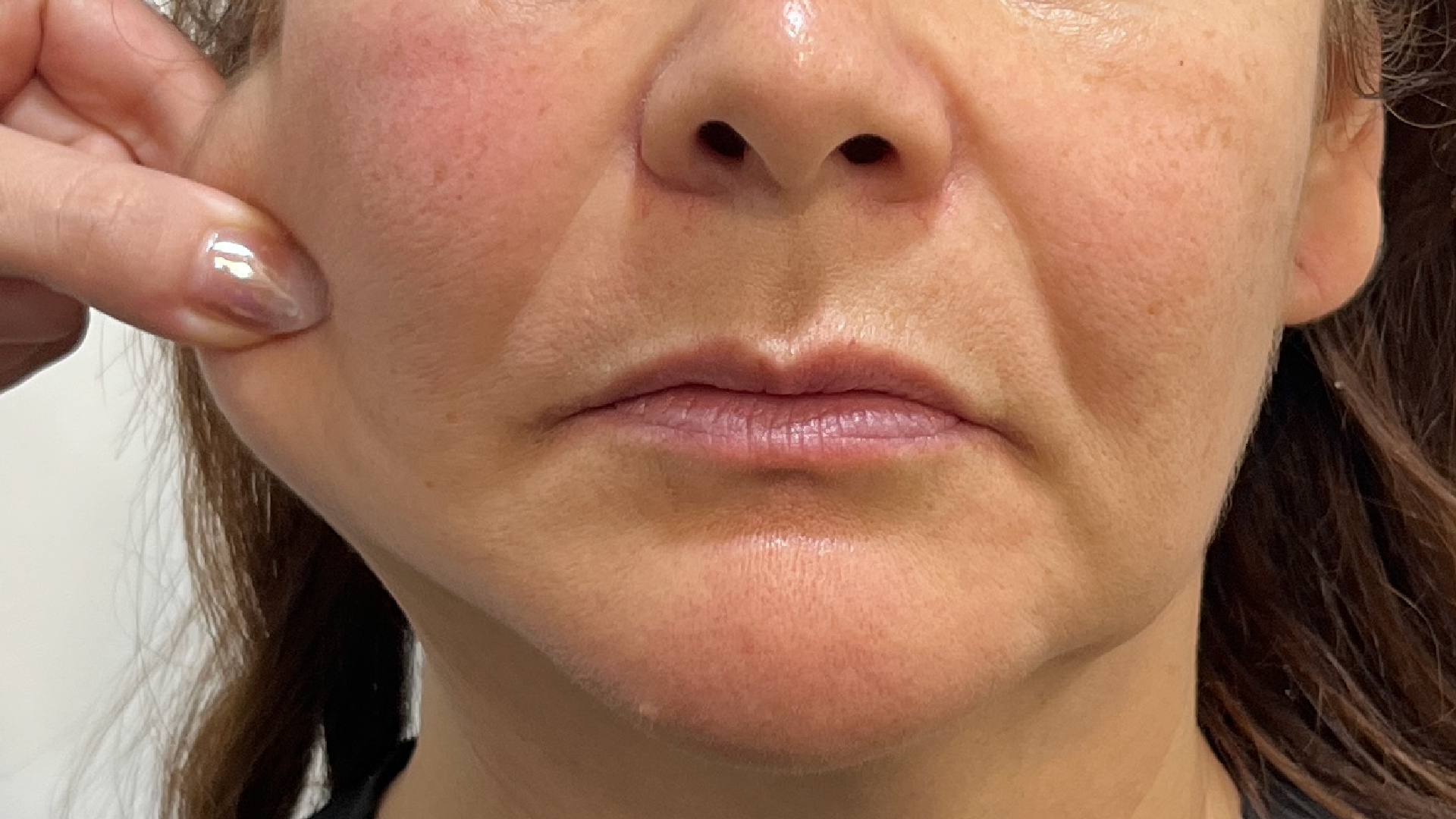 Radiesse_Optimizada Tratamiento profesional de Bioestimulación de colágeno, Sculptra en Bogotá